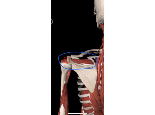 棘上筋腱断裂ですわ